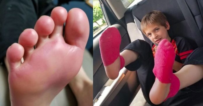 Light-sneakers-burn-feet
