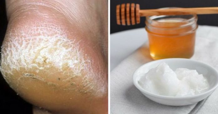cracked-heels-home-remedies