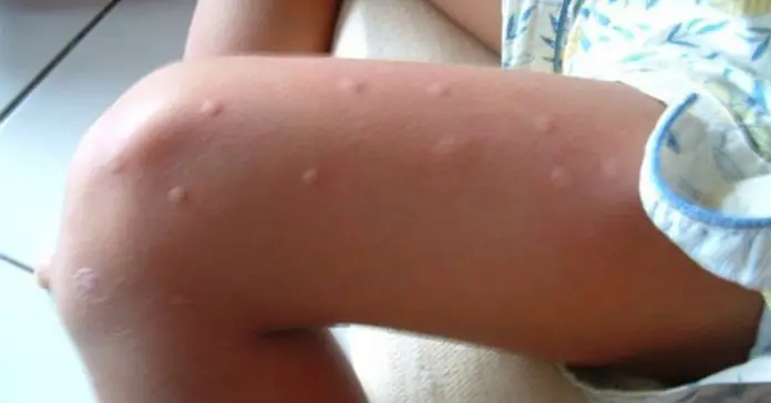 mosquitoes-magnet