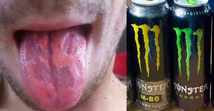 tongue-eaten-away-energy-drinks