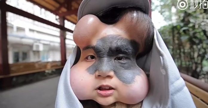 Xiao-Yan-balloons-Cancerous-Birthmark