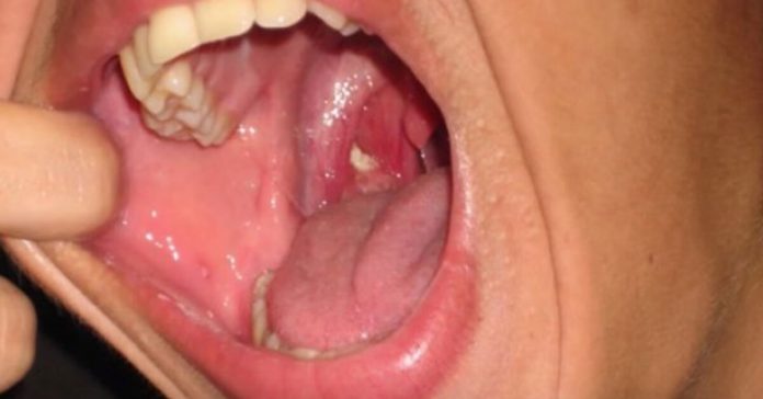 bad-breath-tonsil-stones