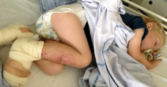 3-year-old-boy-almost-loses-toes