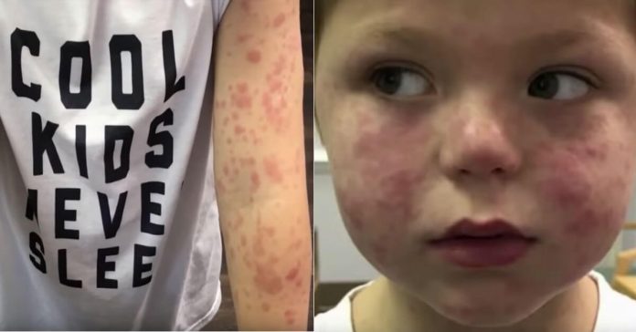 Tick-bites-rocky-mountain
