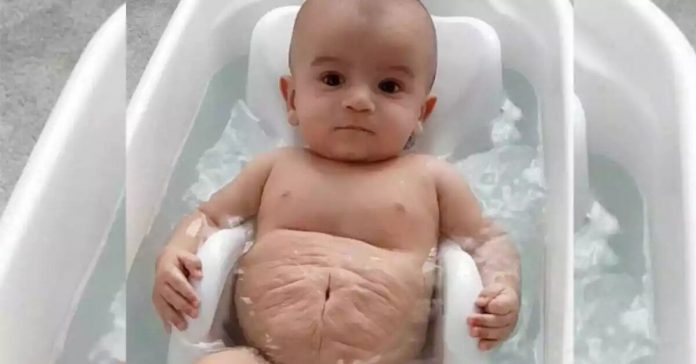 baby-prune-belly