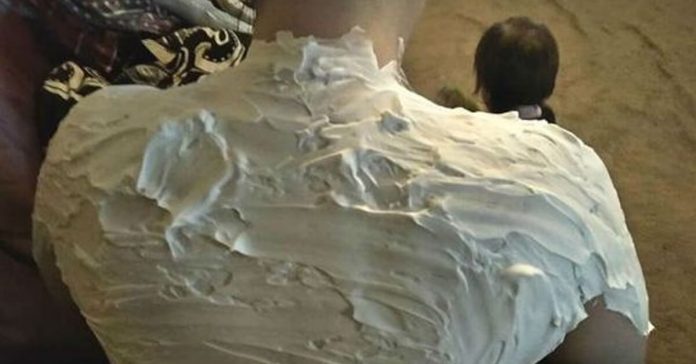 curing-sunburns-with-shaving-cream