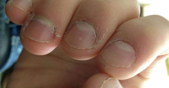 man-biting-nails-sepsis