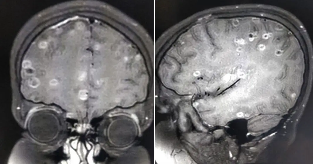 Doctors Find 100 Tapeworm Eggs Inside Brain Of 8YearOld