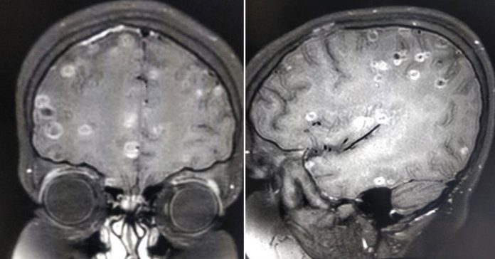 tapeworm-eggs-in-brain
