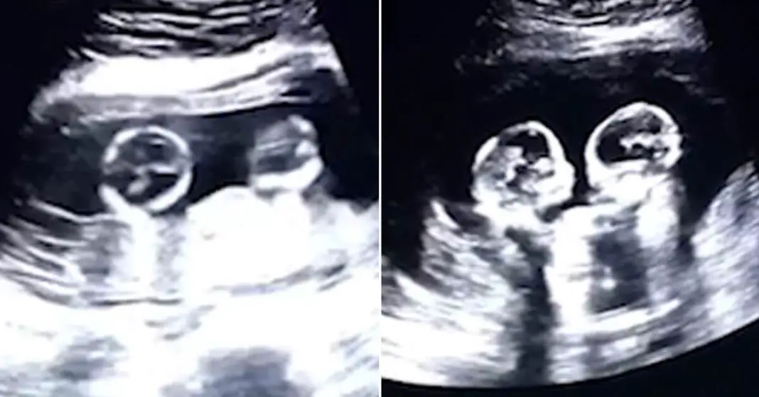 Identical Twins Caught ‘Fighting’ In Woman’s Womb During Ultrasound