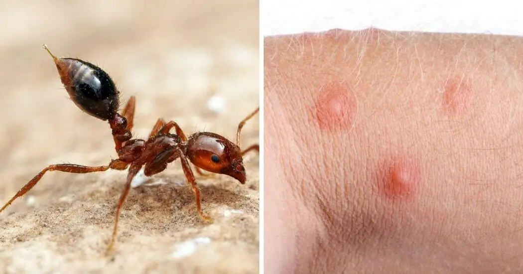 12 Common Bug Bites And How To Recognize Each One 12 Common Bug Bites And How To Recognize Each One