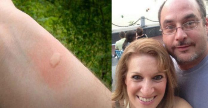 Babesia-tick-bite