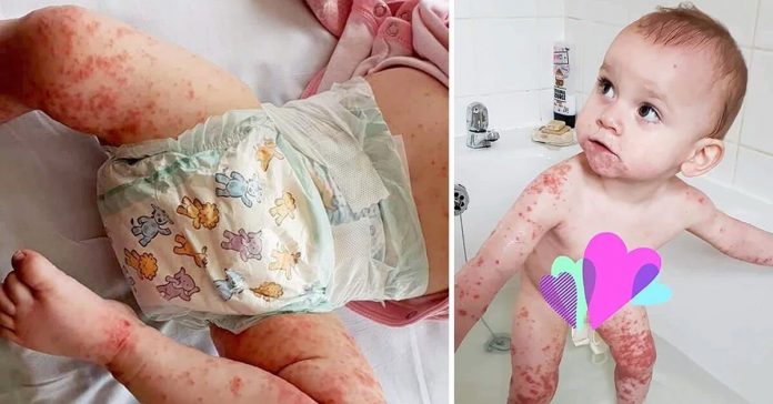Baby-Contracts-Herpes