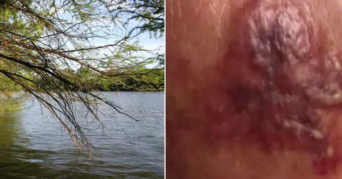 flesh-eating-bacteria