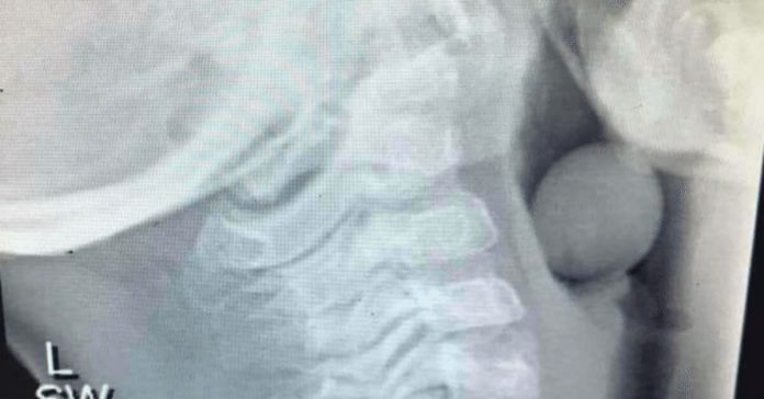 x-ray-of-childs-throat