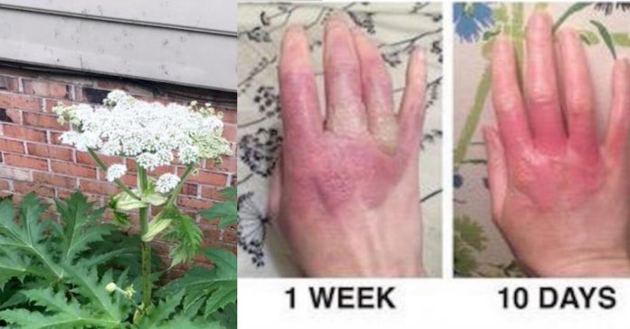 hogweed-plant-causes-burns-blindness