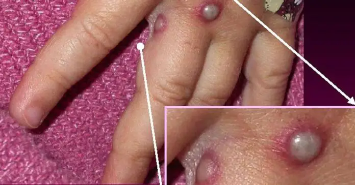 monkeypox